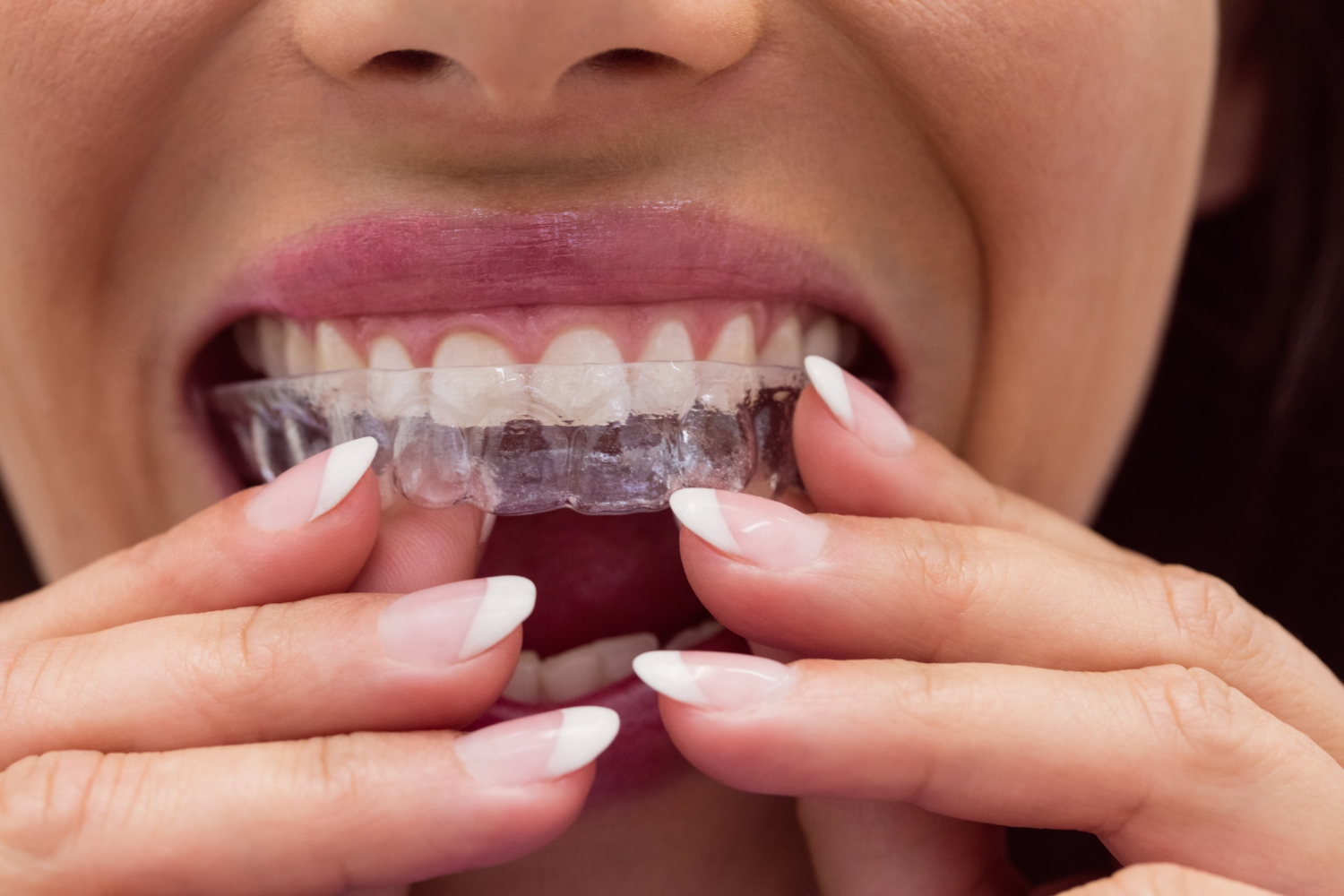 La ortodoncia invisible como aliada para mejorar tu salud bucodental